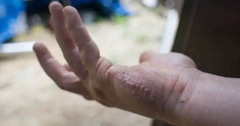 using super glue on cuts